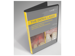 Video The Diode Laser: A step by step EN
